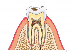 むし歯の進行　C1